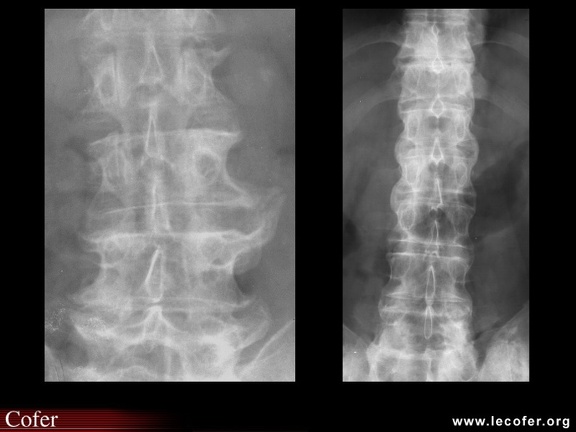 Spondylarthrite ankylosante / SpA / pelvispondylite rhumatismale /  spondylarthropathie