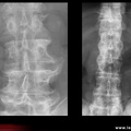 Spondylarthrite ankylosante / SpA / pelvispondylite rhumatismale /  spondylarthropathie