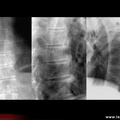 Spondylarthrite ankylosante / SpA / pelvispondylite rhumatismale / spondylarthropathie