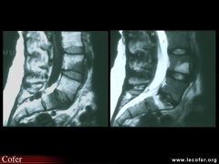 Spondylarthrite ankylosante / SpA / pelvispondylite rhumatismale / spondylarthropathie