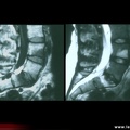 Spondylarthrite ankylosante / SpA / pelvispondylite rhumatismale / spondylarthropathie