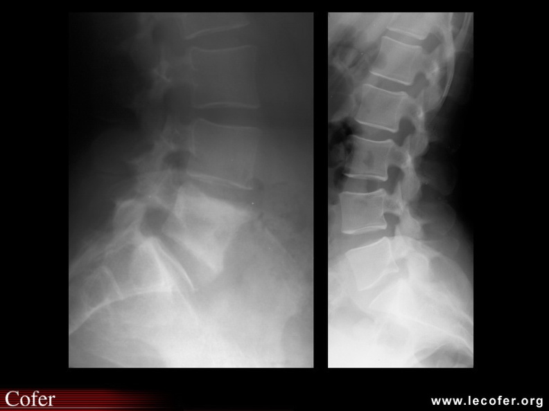 Spondylarthrite ankylosante / SpA / pelvispondylite rhumatismale ...