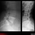 Spondylarthrite ankylosante / SpA / pelvispondylite rhumatismale / spondylarthropathie : spondylite condensante (SAPHO)