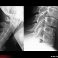 Spondylarthrite ankylosante / SpA / pelvispondylite rhumatismale / spondylarthropathie