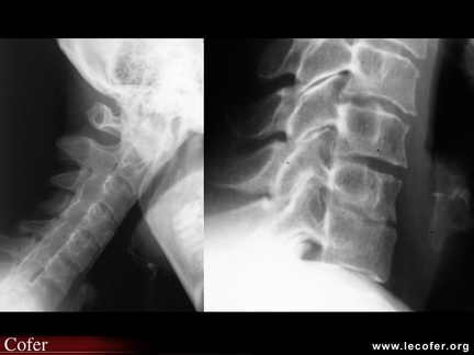 Spondylarthrite ankylosante / SpA / pelvispondylite rhumatismale / spondylarthropathie