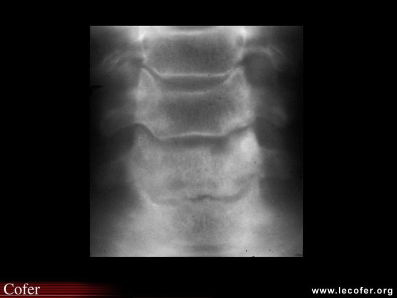 Spondylarthrite ankylosante / SpA / pelvispondylite rhumatismale / spondylarthropathie : Spondylodiscite inflammatoire (SAPHO)