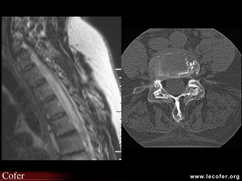 Spondylarthrite ankylosante / SpA / pelvispondylite rhumatismale / spondylarthropathie