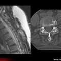 Spondylarthrite ankylosante / SpA / pelvispondylite rhumatismale / spondylarthropathie