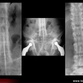 Spondylarthrite ankylosante / SpA / pelvispondylite rhumatismale / spondylarthropathie