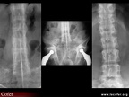 Spondylarthrite ankylosante / SpA / pelvispondylite rhumatismale / spondylarthropathie