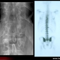 Spondylarthrite ankylosante / SpA / pelvispondylite rhumatismale / spondylarthropathie