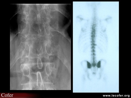 Spondylarthrite ankylosante / SpA / pelvispondylite rhumatismale / spondylarthropathie