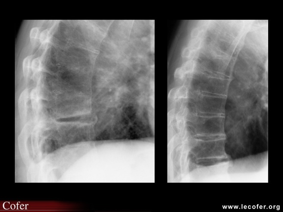 Spondylarthrite ankylosante / SpA / pelvispondylite rhumatismale / spondylarthropathie : la fracture de l’arc postérieur