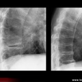 Spondylarthrite ankylosante / SpA / pelvispondylite rhumatismale / spondylarthropathie : la fracture de l’arc postérieur