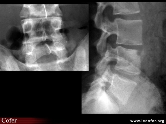 Spondylodiscite infectieuse