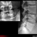 Spondylodiscite infectieuse