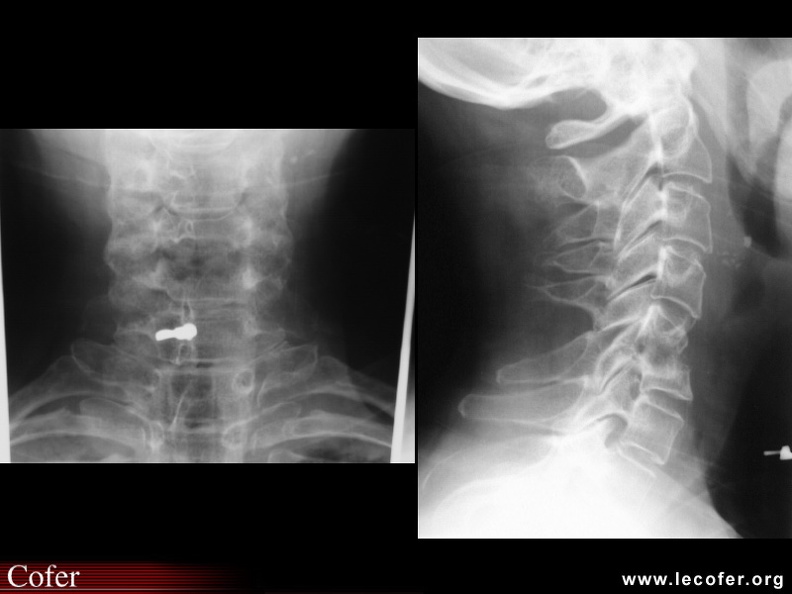 Spondylodiscite infectieuse C5-C6 à pyogènes. Radiographie standard, face. Ostéolyse inférieure du corps de C5 et ostéolyse supérieure du corps de C6. Radiographie standard, profil. Ostéolyse supérieure du corps de C6 et surtout ostéolyse inférieure du corps de C5. Effondrement du corps de C5 avec recul du mur postérieur, bascule de C5 sur C6 et subluxation des articulaires postérieures en C5-C6. Discrète condensation du corps de C6. 040002006.jpg