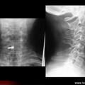 Spondylodiscite infectieuse avec ostéolyse vertébrale