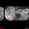 Spondylodiscite infectieuse : ponction discale