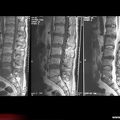 Spondylodiscite infectieuse