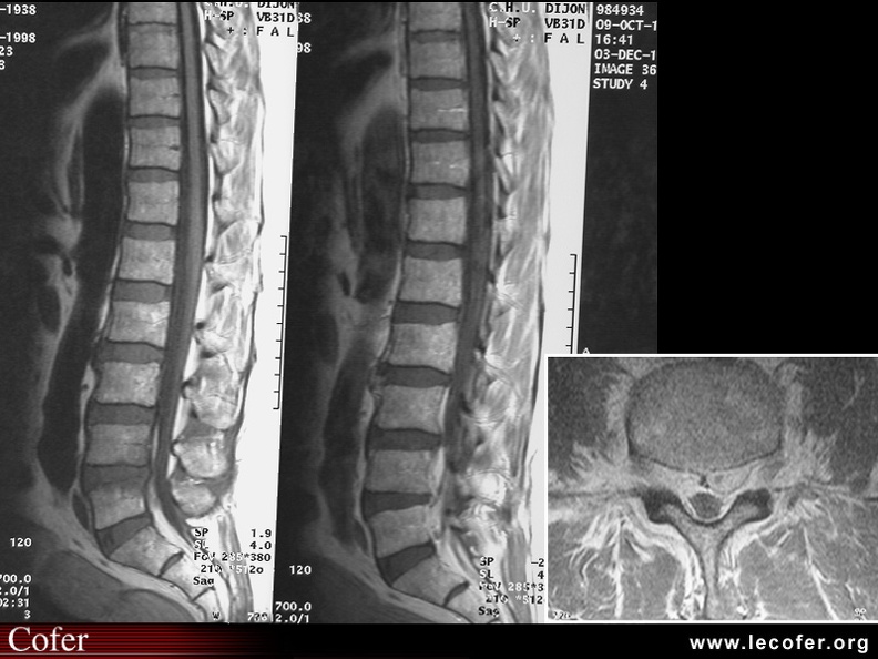 Spondylite infectieuse et épidurite