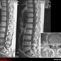 Spondylite infectieuse et épidurite