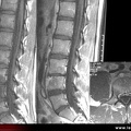 Spondylite infectieuse à pyogènes, spondylodiscite infectieuse