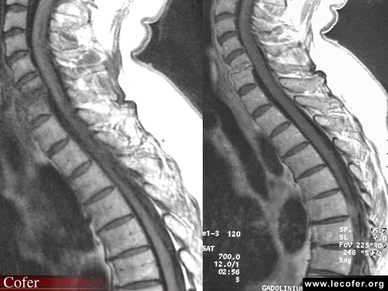 Spondylodiscite infectieuse, spondylodiscite infectieuse traitée depuis 2 mois, spondylodiscite infectieuse