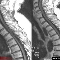 Spondylodiscite infectieuse, spondylodiscite infectieuse traitée depuis 2 mois, spondylodiscite infectieuse