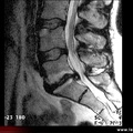 Spondylodiscite infectieuse