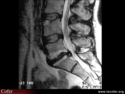 Spondylodiscite infectieuse