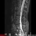 Spondylodiscite infectieuse