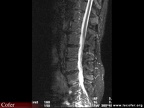 Spondylodiscite infectieuse