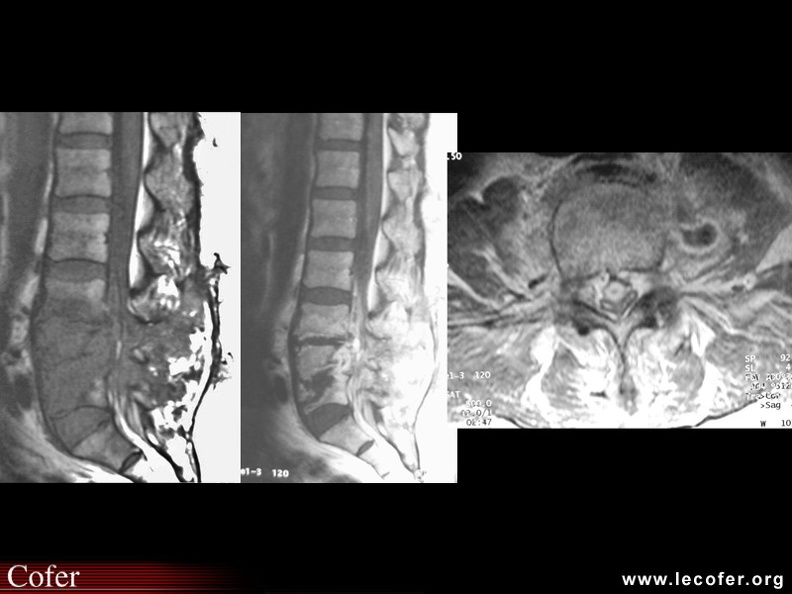 Spondylodiscite infectieuse avec épidurite et abcès psoas, spondylodiscite infectieuse