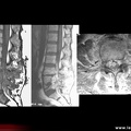 Spondylodiscite infectieuse avec épidurite et abcès psoas, spondylodiscite infectieuse