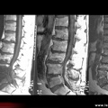 Spondylodiscite infectieuse multifocale, spondylodiscite infectieuse