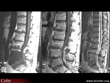 Spondylodiscite infectieuse multifocale, spondylodiscite infectieuse