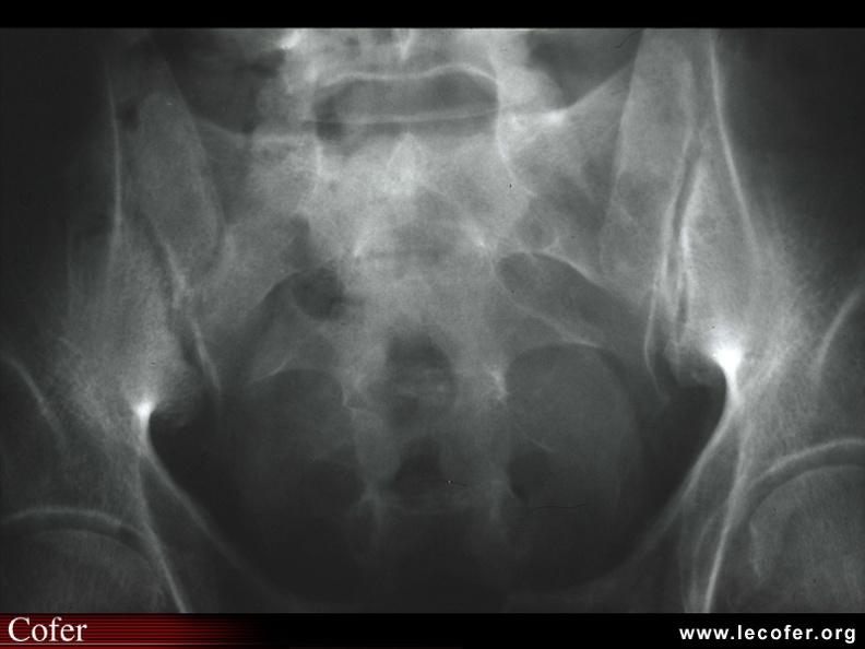 Sacroiliite infectieuse droite à pyogènes débutante. Radiographie simple. Aspect flou et pseudo-élargissement de l'interligne articulaire. 040002035.jpg