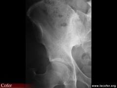 Sacroiliite Infectieuse. Radiographie évoluée