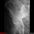 Sacroiliite Infectieuse. Radiographie évoluée