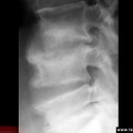 Mal de Pott, tuberculose vertébrale, tuberculose ostéoarticulaire. Radiographie