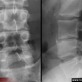 Mal de Pott, tuberculose vertébrale, tuberculose ostéoarticulaire. Radiographie