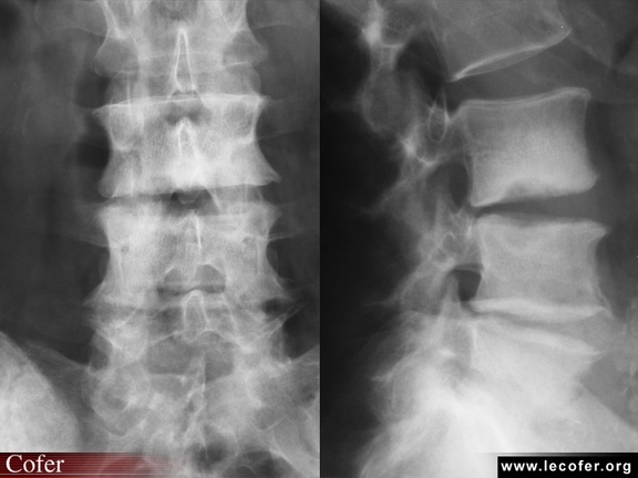 Mal de Pott, tuberculose vertébrale, tuberculose ostéoarticulaire. Radiographie