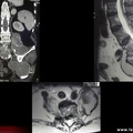 Mal de Pott, tuberculose vertébrale, tuberculose ostéoarticulaire