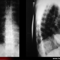 Radiographies normales du rachis dorsal (face et profil)