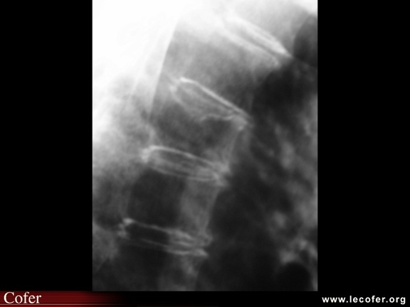 Fracture vertébrale de grade 1 du rachis dorsal