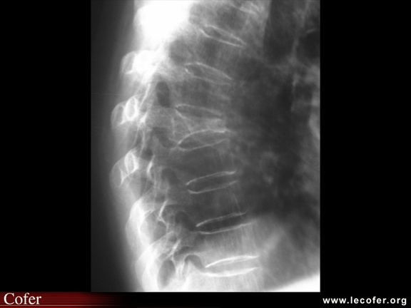 Fracture vertébrale de grade 3 du rachis dorsal