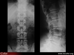 Radiographies normales du rachis lombaire (face et profil)