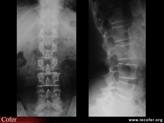 Radiographies normales du rachis lombaire (face et profil)