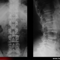 Radiographies normales du rachis lombaire (face et profil)